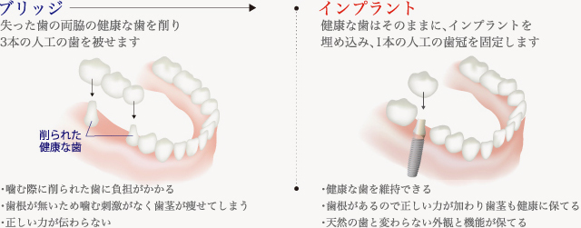 ブリッジとの比較図