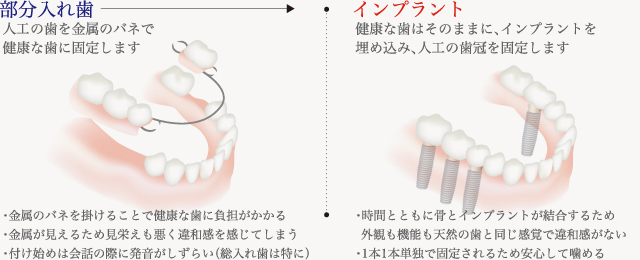 部分入れ歯との比較図